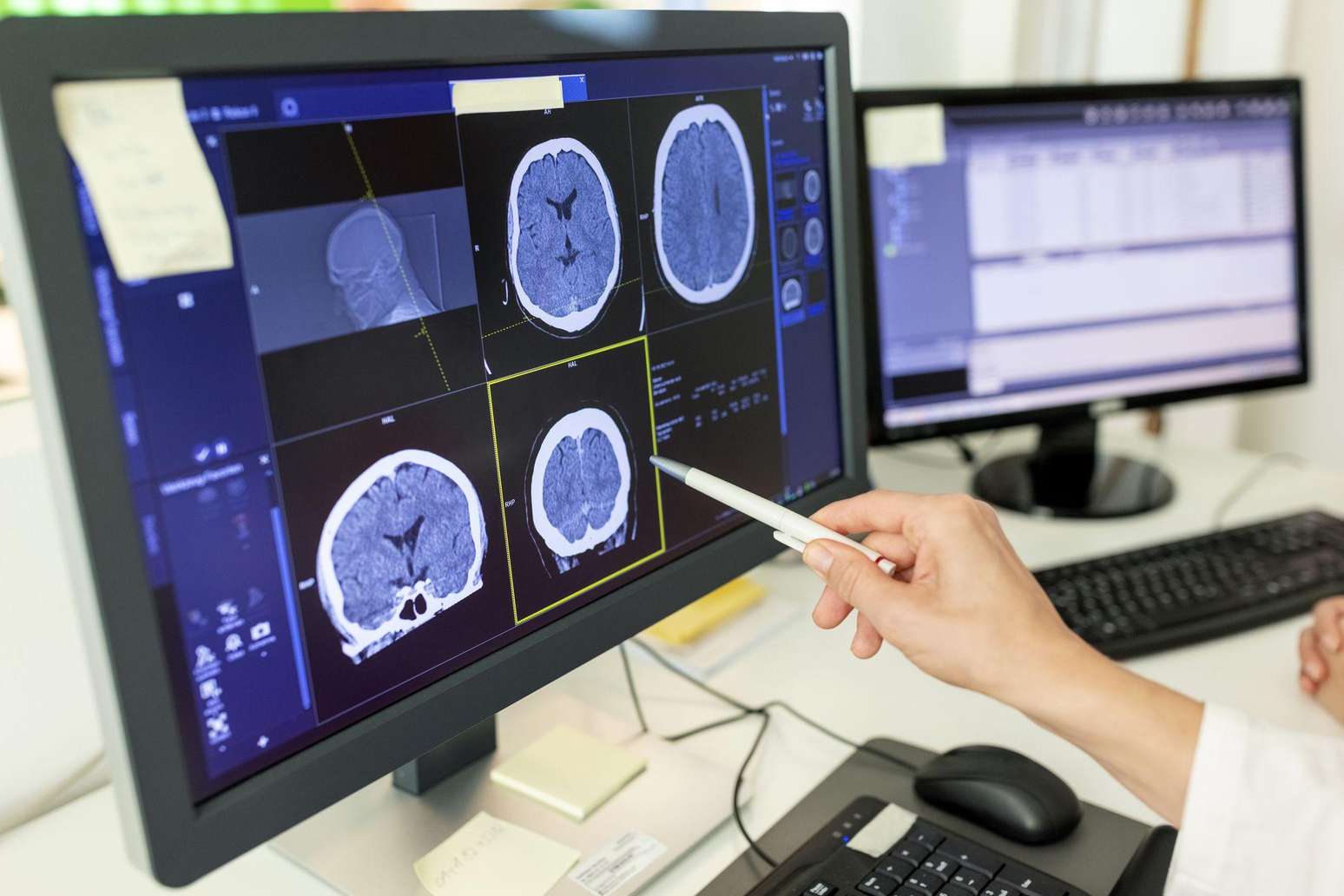Close-up de uma médica analisando o laudo de uma tomografia computadorizada em um monitor de computador